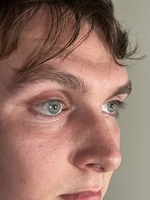 Durchbruch: Perfektes Computergenerierte Augenprothesen aus dem 3D-Drucker überzeugen in der Praxis