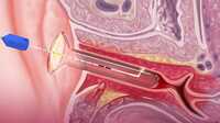 Leonardo Dual Diodenlaser wirksam bei urogenitalem Menopausensyndrom